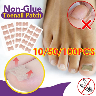 #ad 100Pcs Elastic Ingrown Toenail Corrector Stickers Toenail Patch Non Glue Toe US $4.17